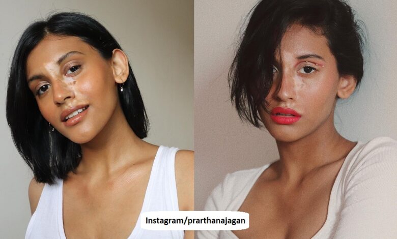 Prarthana Jagan Vitiligo