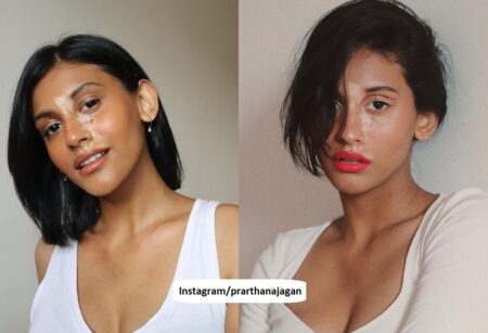 Prarthana Jagan Vitiligo