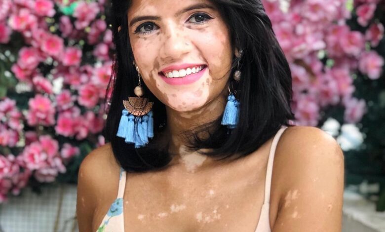 sonya danita charles vitiligo