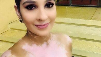 Guyana Woman accepting Vitiligo