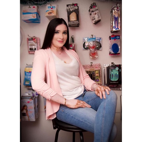 Tashana Sasha Ramdeholl Beauty shop Vitiligo