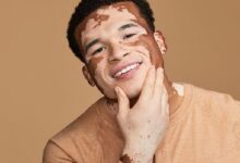 Vitiligo Male Model USA Curtis McDaniel