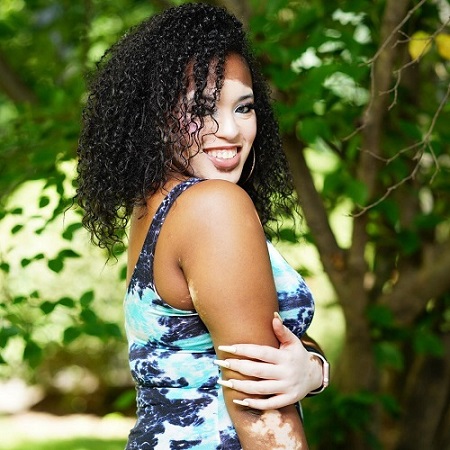 Vitiligo Model Dancer Mariah Perkins USA