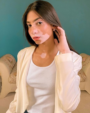 Pakistan woman with vitiligo
