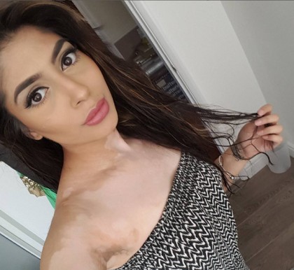 Vitiligo makeup artist london sonam rajal