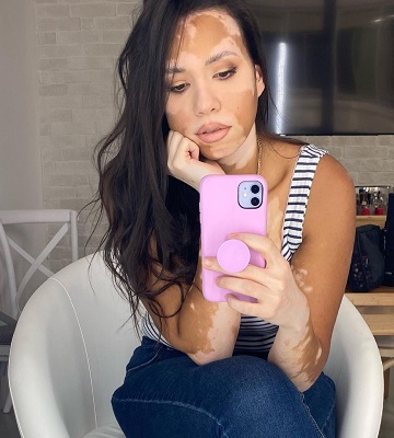 Vitiligo woman in Dubai UAE