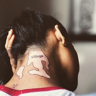 the vitiligo girl pakistan