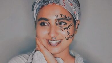 Vitiligo Pakistan woman Mehak