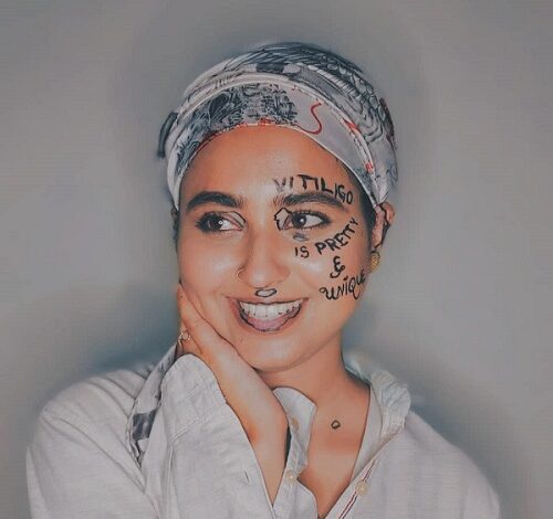 Vitiligo Pakistan woman Mehak