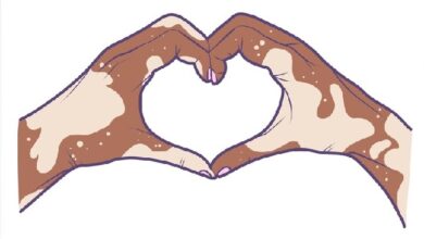 Vitiligo Dating Tips