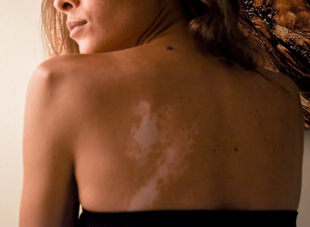 Woman having vitiligo spots on her back