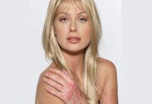 American Model CariDee English Psoriasis