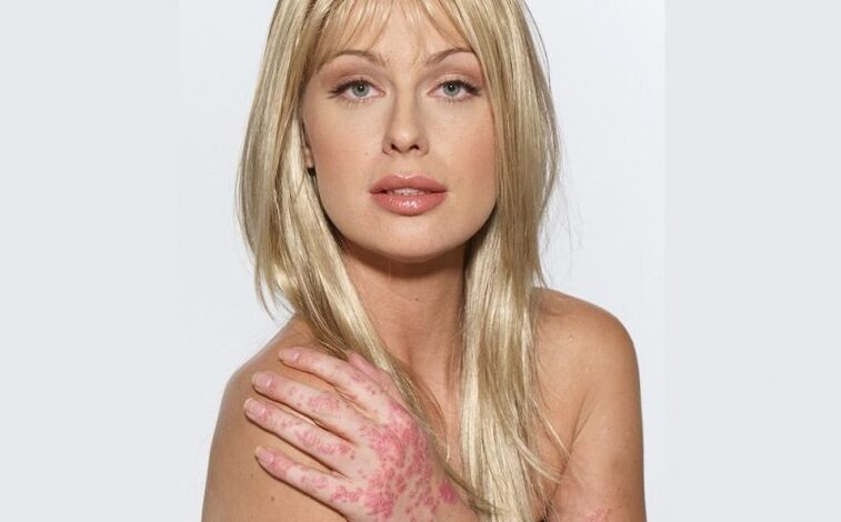 CariDee English proudly flaunts her psoriasis to inspire others 1 American Model CariDee English Psoriasis