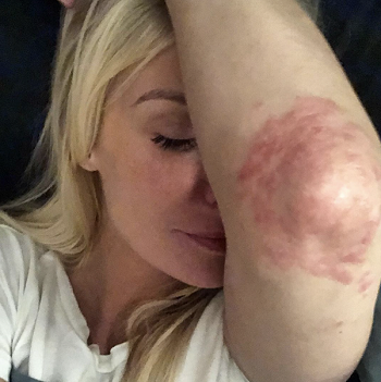 CariDee English proudly flaunts her psoriasis to inspire others 3 CariDee English psoriasis on knees